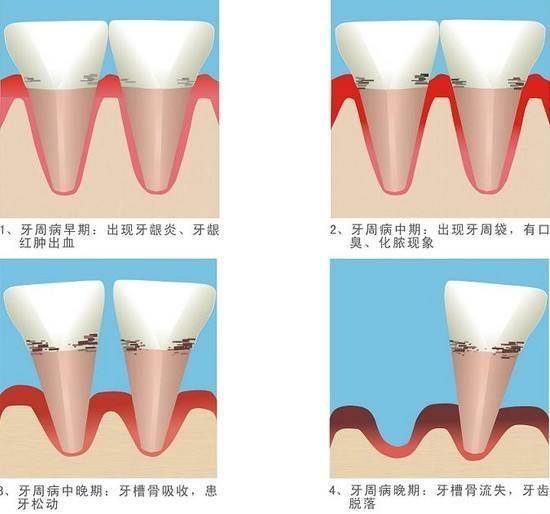 牙周炎或?qū)е掳柎暮Ｄ?患者